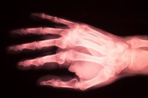 Хирургическое лечение синдрома щелкающего пальца